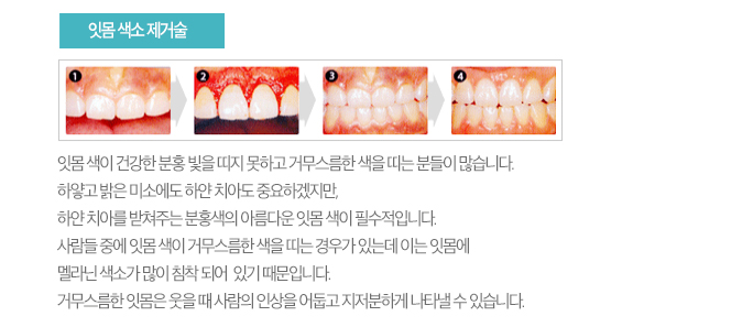 잇몸색소 제거술