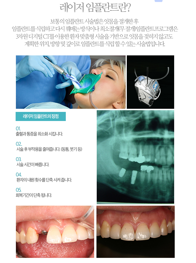 과학의 발전에 힘입은 레이저 임플란트!